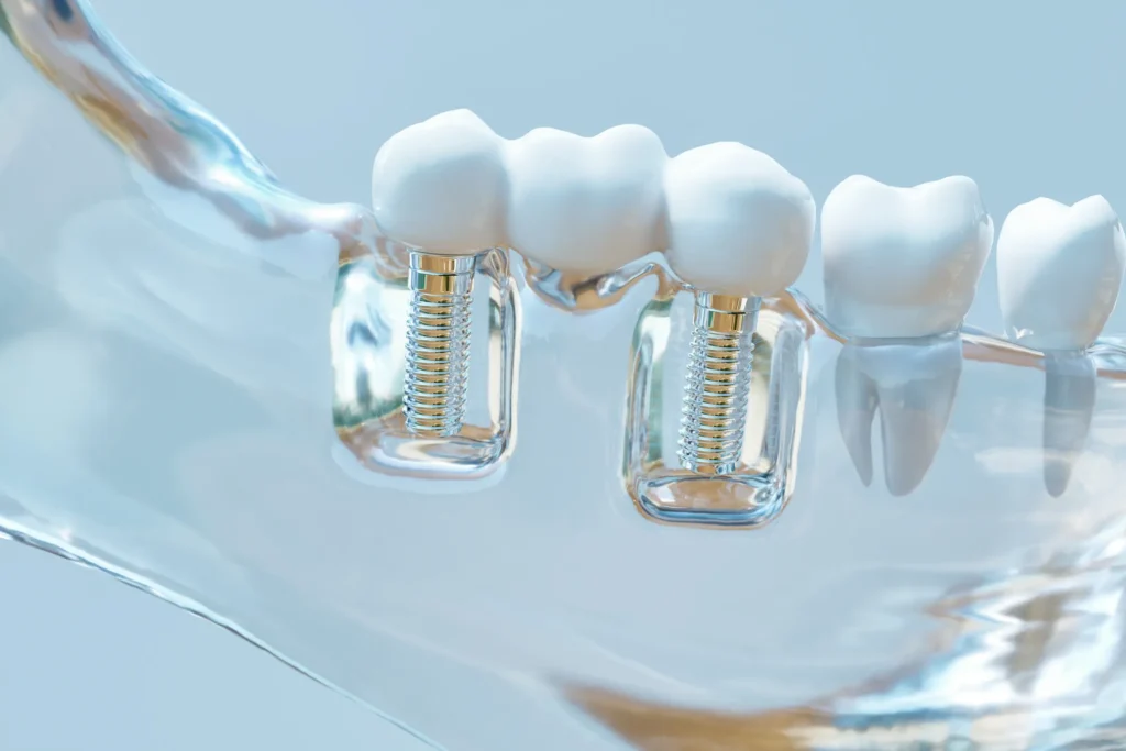 Different Types of Dental Implants: Which is Best?