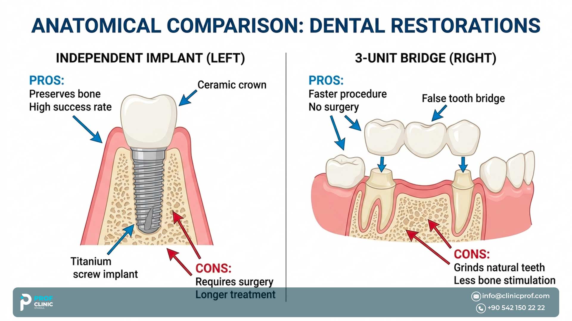 A Dental Implant or a Bridge: What’s Better?