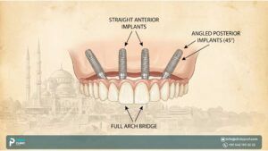 All-on-4 Dental Implants in Turkey: Cost & Advantages