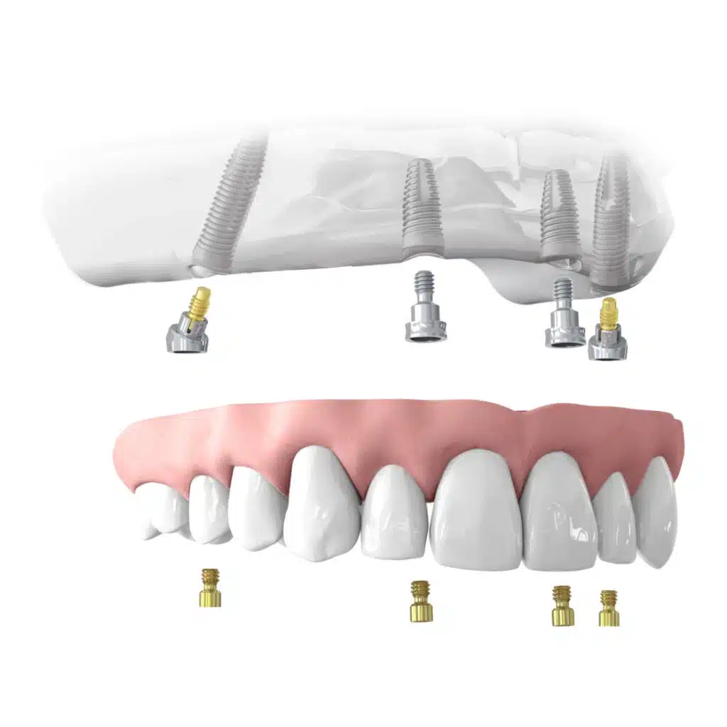 All-on-4 Dental Implants in Turkey: Cost & Advantages