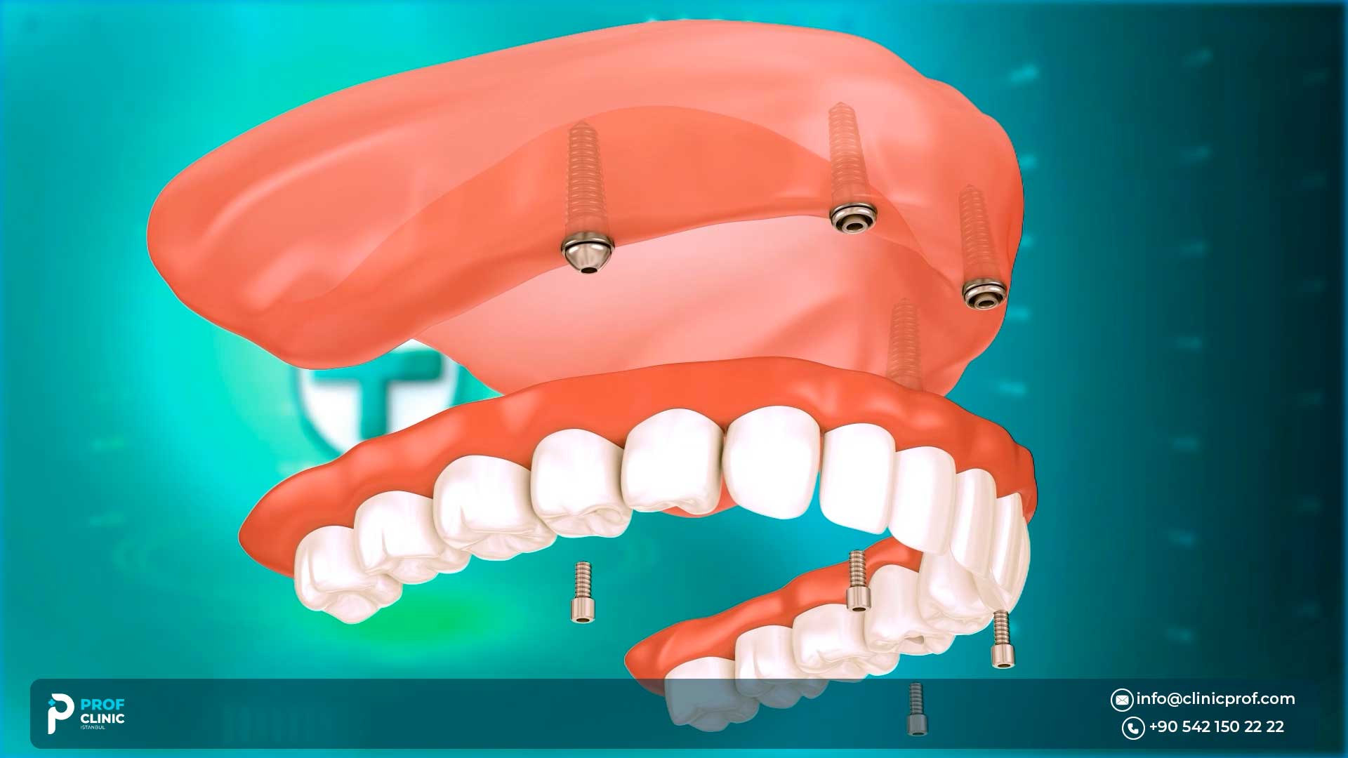 What is the All on Four Dental Implants Procedure?

