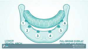 All on 6 Dental Implants: Everything you want to know