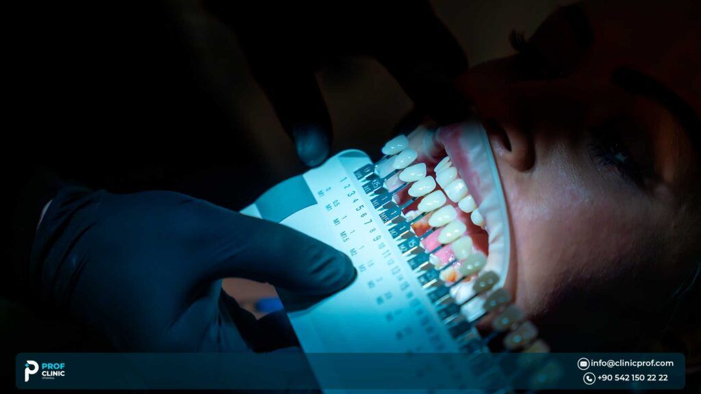 Average Price for a Full Set of Veneers