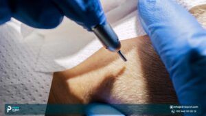Best DHI Hair Transplant in Turkey: Everything you want to know