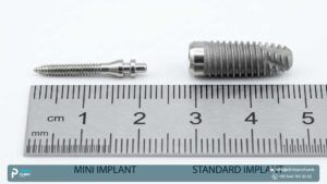 Best Mini Dental Implants (MDI): pros, cons, cost