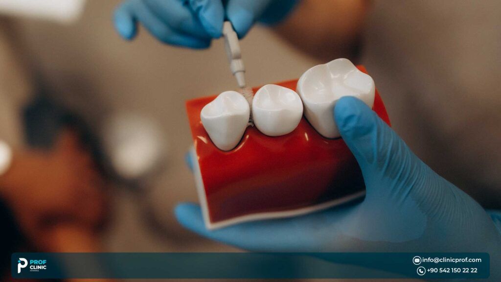 Common Issues with Dental Crowns