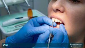 Composite Veneers: Everything You Need to Know