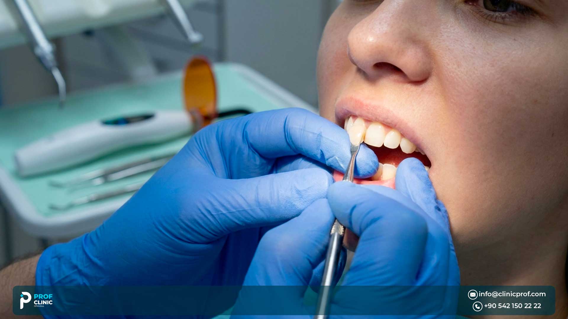 Composite Veneers: Everything You Need to Know