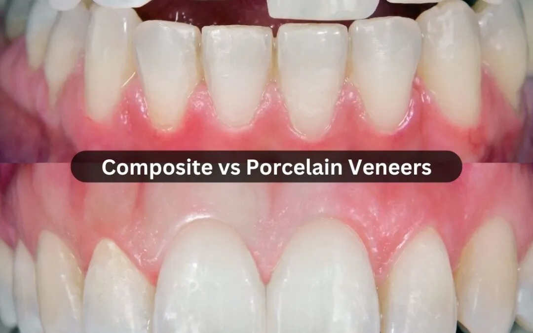 Composite vs. Porcelain Veneers: Everything You Need to Know