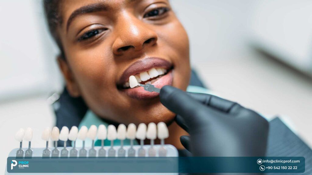 Cons of Veneers Without Shaving Teeth