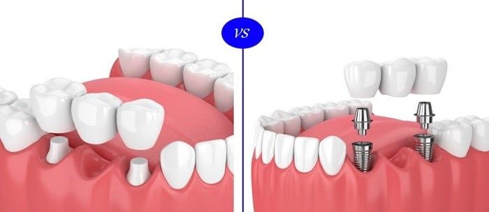 A Dental Implant or a Bridge: What’s Better?