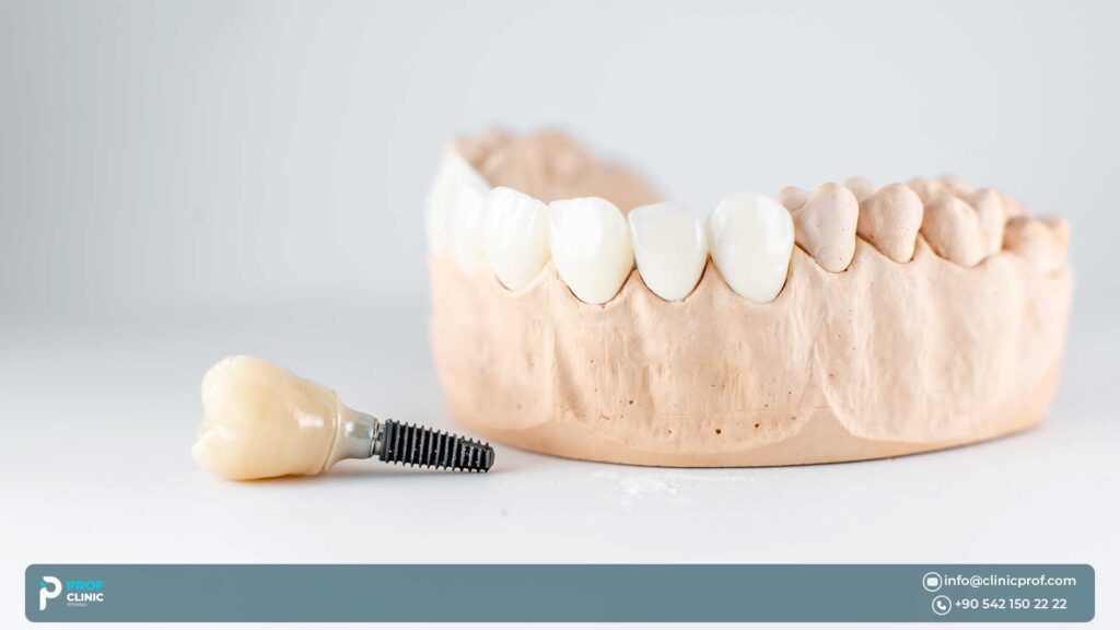 Dental Implants in Istanbul