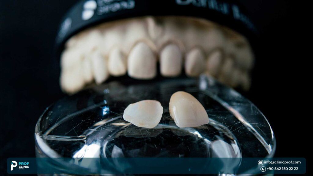 Dental Veneer Cost - Prof Clinic