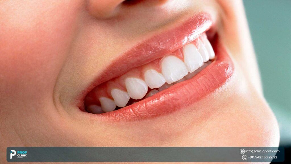 Difference Between Veneers and Direct Veneers
