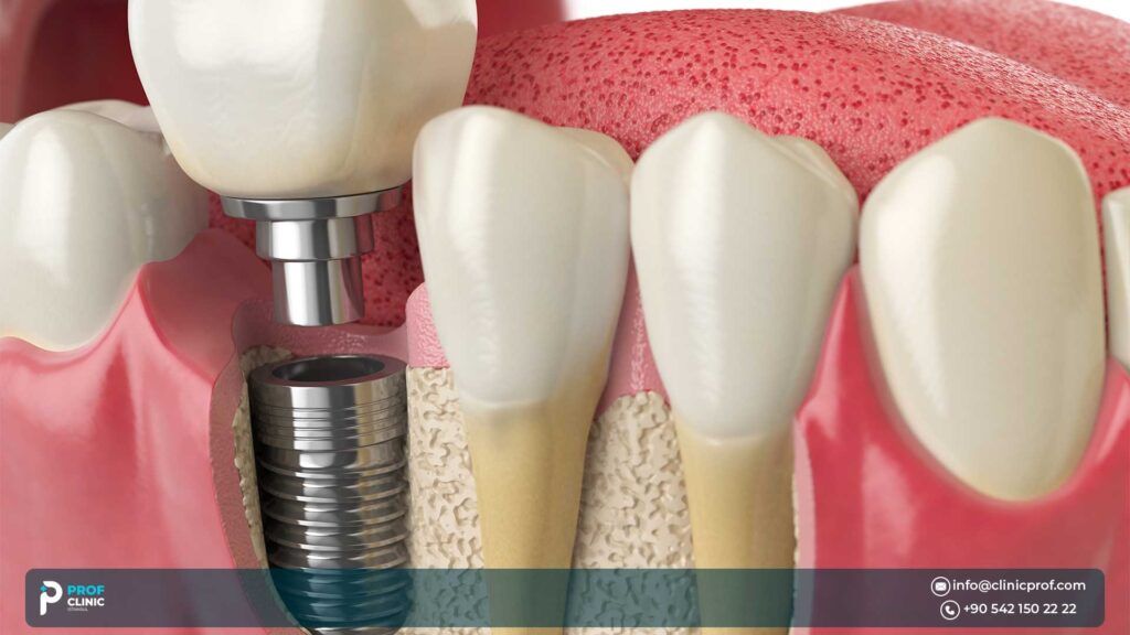 Different types of Dental Implants