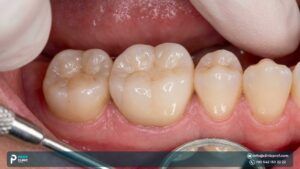 Enhancing Your Smile, The Benefits of Dental Implant Zirconia Crowns