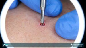 Everything to Know About a FUE Hair Transplant