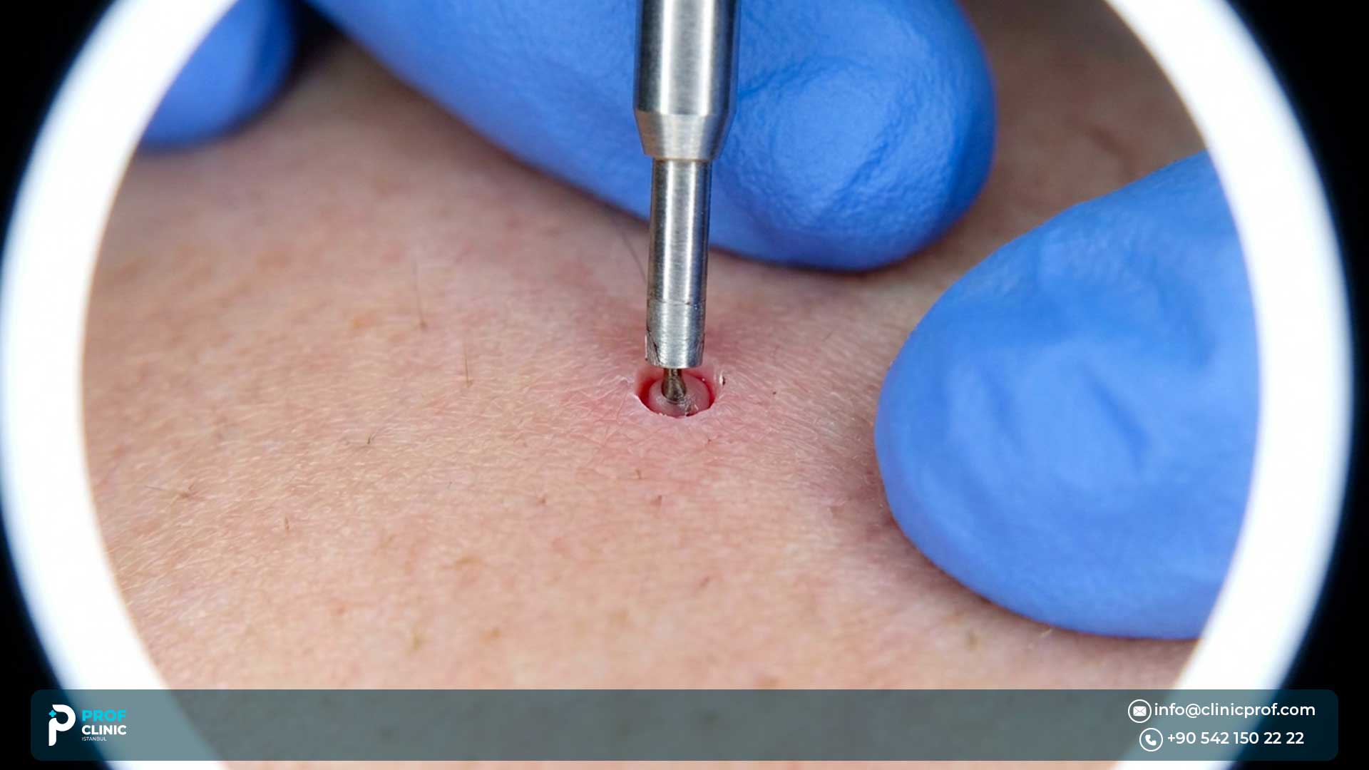 Everything to Know About a FUE Hair Transplant