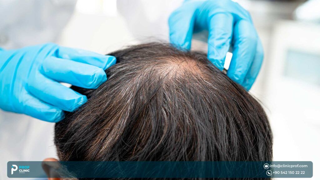 Factors to Consider When Choosing a Country for a Hair Transplant