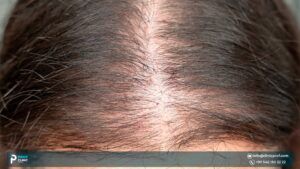 Female Hair Transplant: Causes, Techniques & Cost Explained