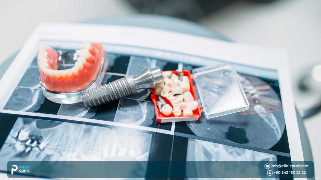 Full Mouth Dental Implants