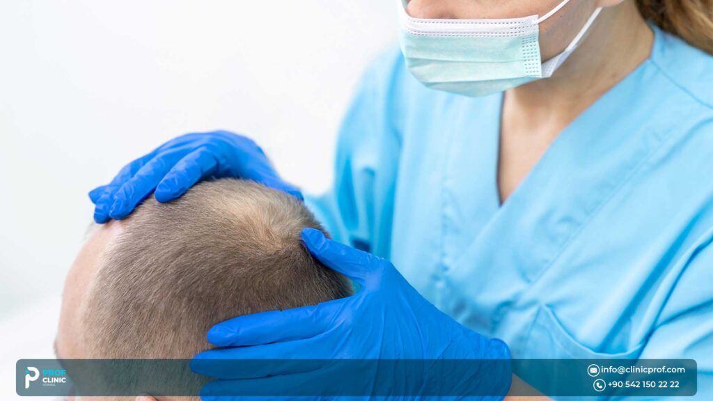  Hair Transplant in Turkey: The Pros & Cons
