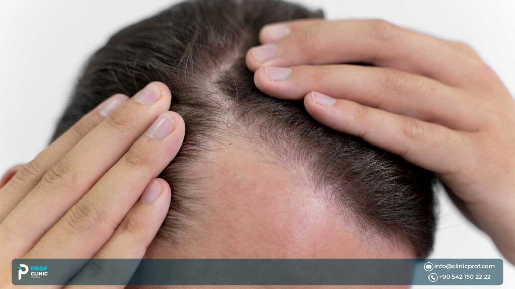 Hair Transplant in the UK: The Pros & Cons