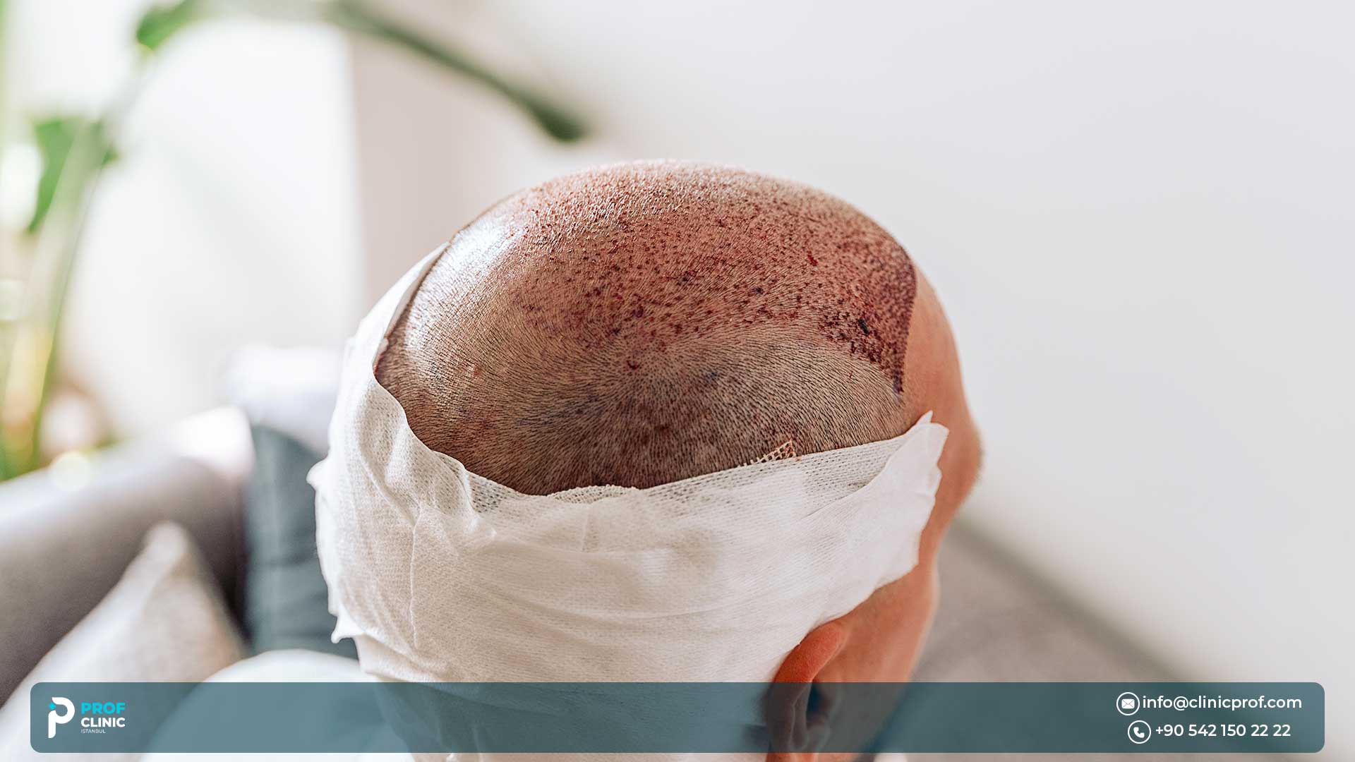Hair Transplants
