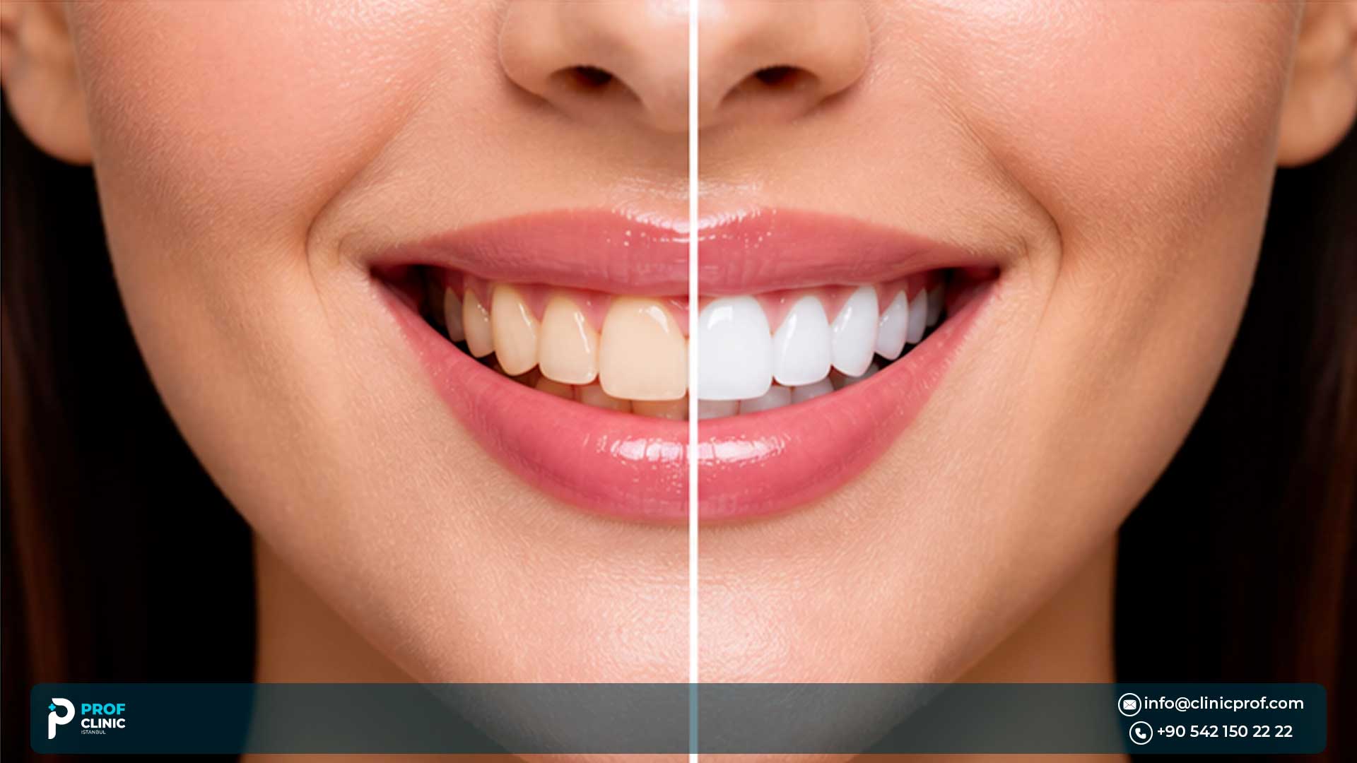 Hollywood Smile Before and After Photos