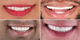 Hollywood Smile Types