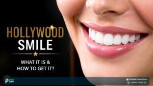Hollywood Smile: What It Is & How to Get It?