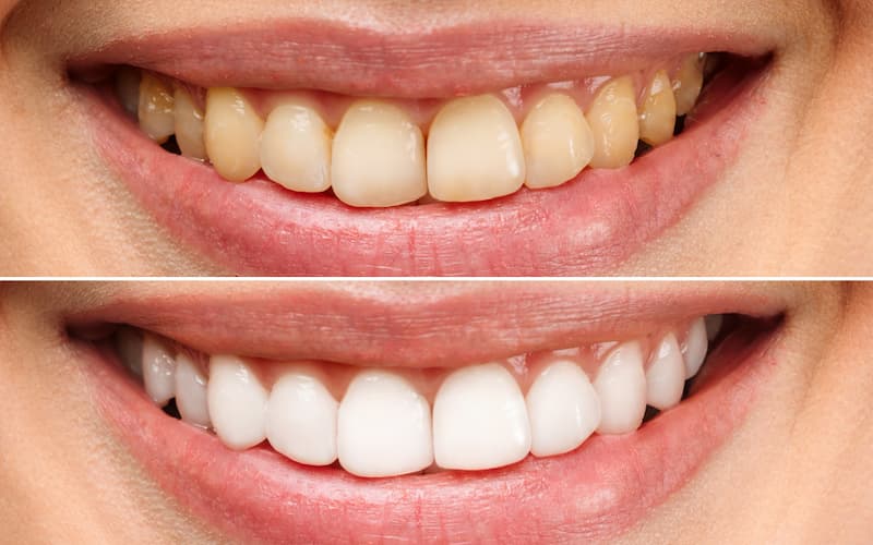 Hollywood Smile in Istanbul - 3 Types of Hollywood Smile in Istanbul - Prof Clinic - أنواع ابتسامة هوليود