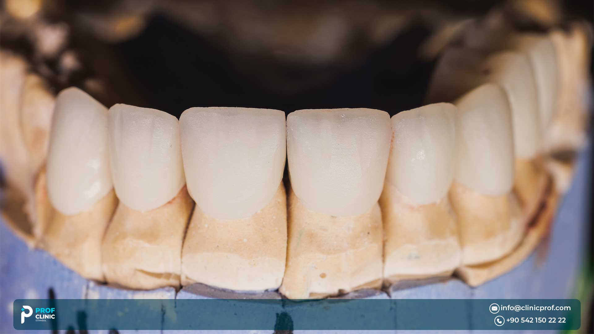 Hollywood Smile vs Veneers