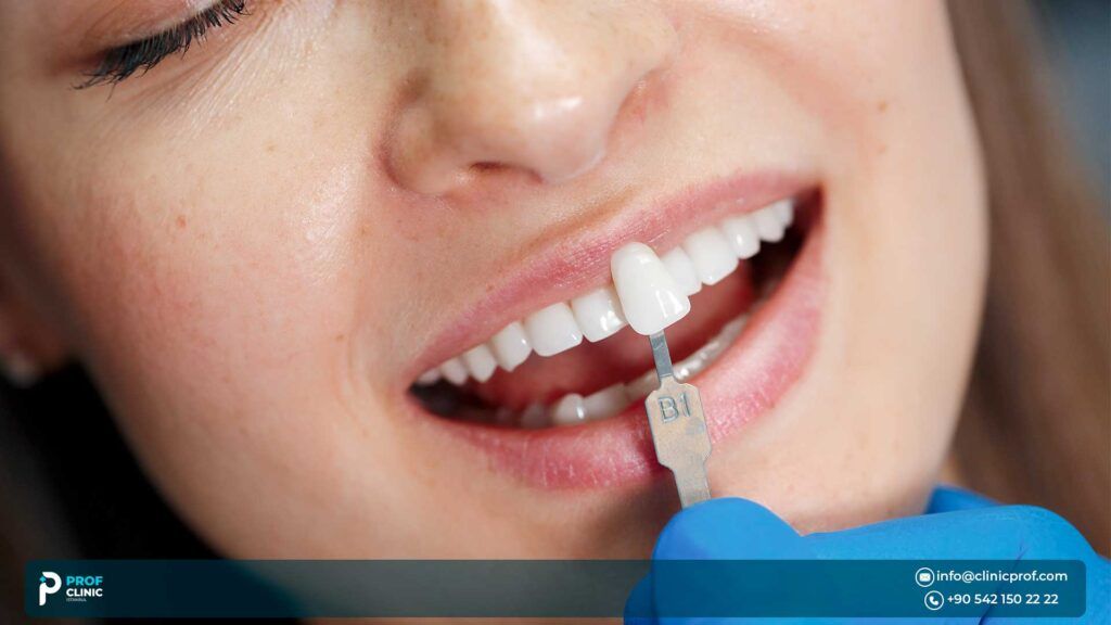 How Are Lumineers Dental Veneers Applied?