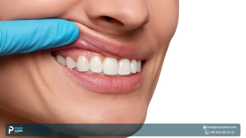 How Much Is a Full Set of Veneers Cost in Turkey?