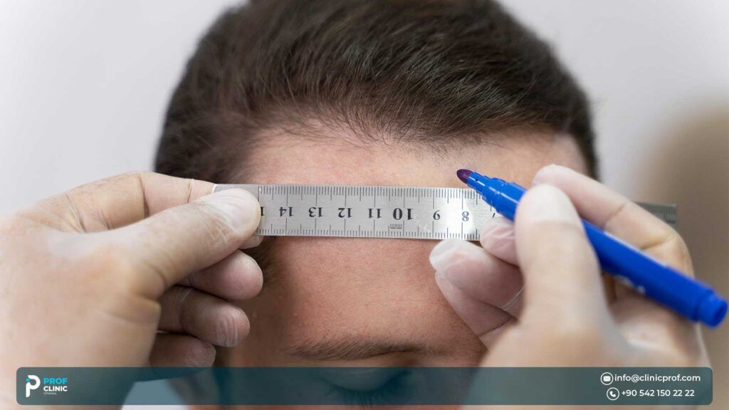 Important Factors of Choosing a Surgeon for Hair Transplant