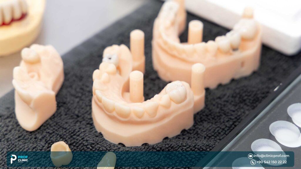 Important advantages of Emax dental crowns