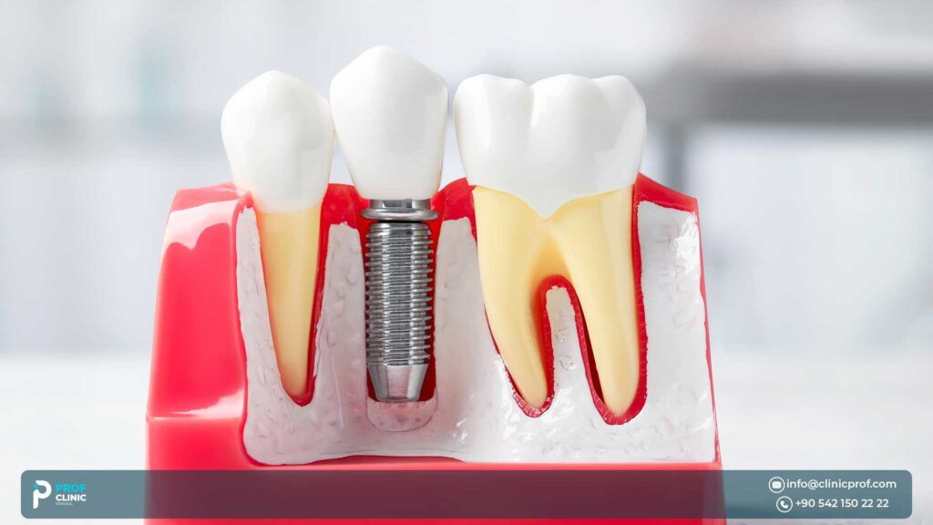 Information About Dental Implants