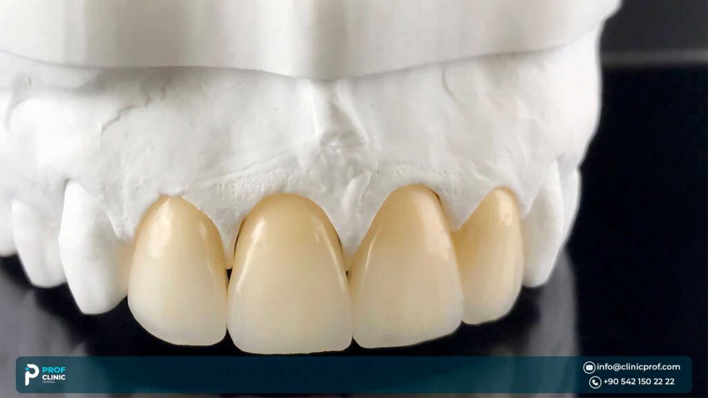 Information about what are the types of zircon crowns: