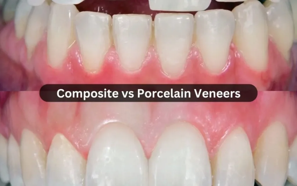 What Are Dental Lumineers?