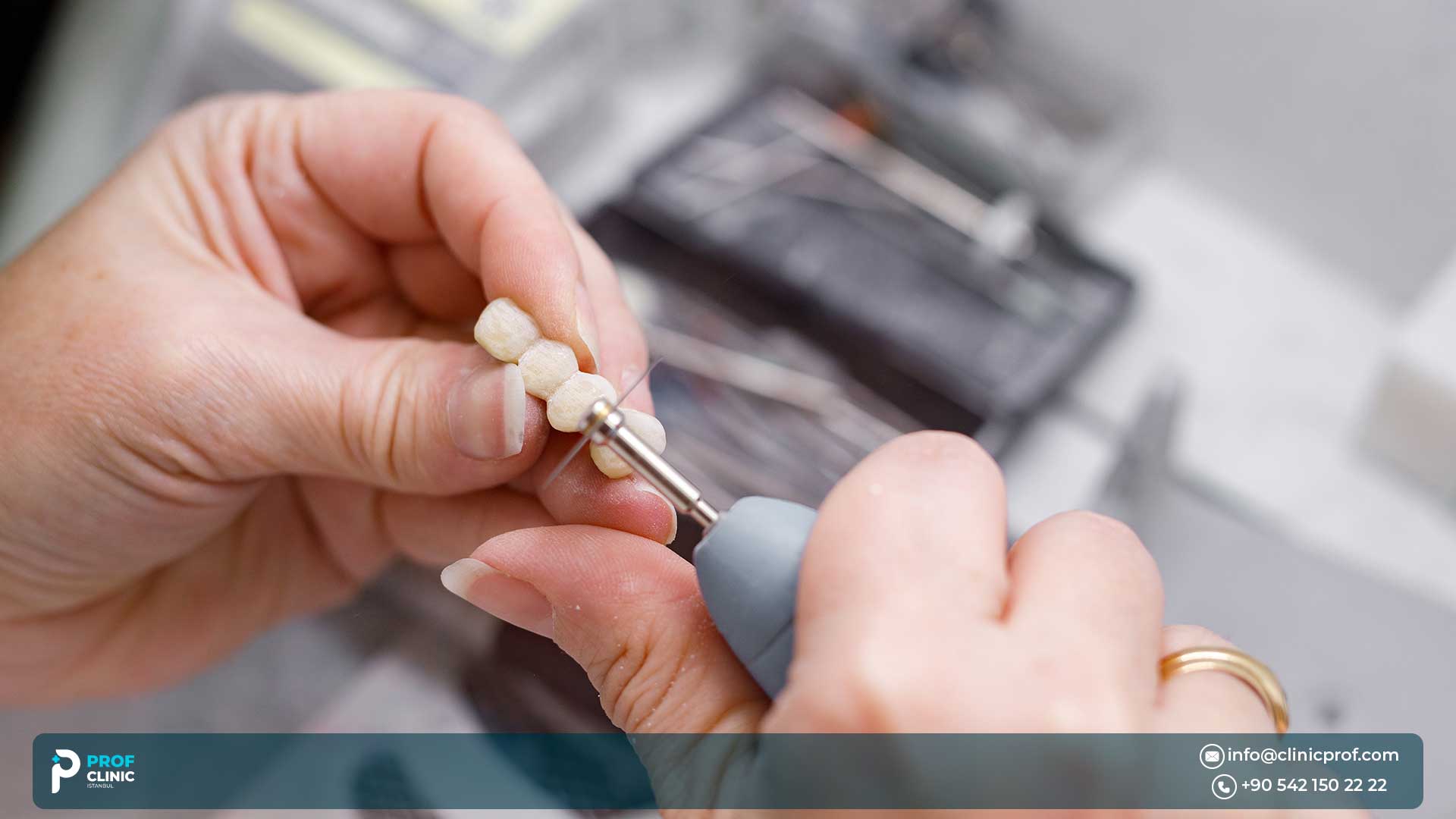 Maintaining Emax Crowns