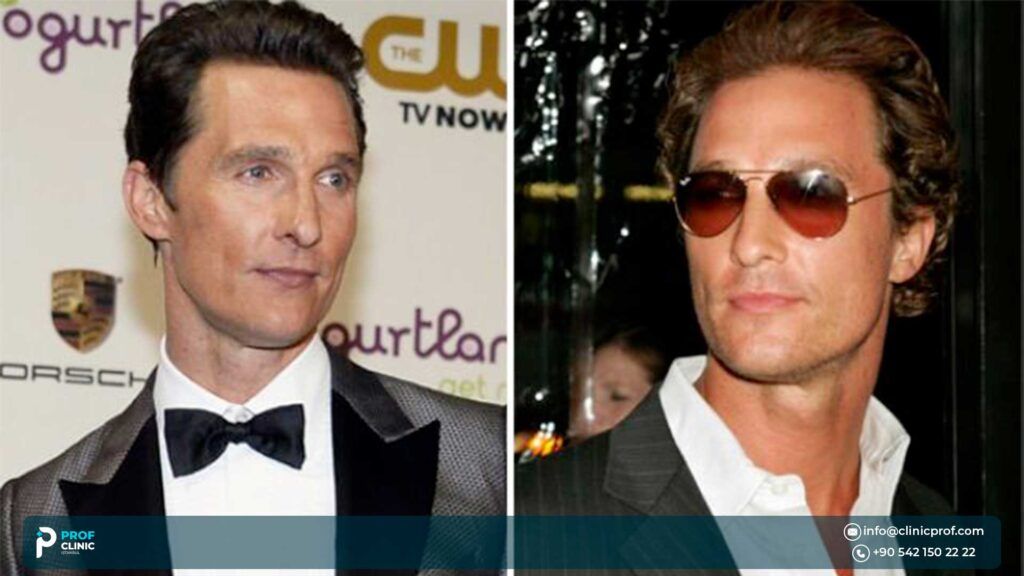 Matthew McConaughey’s Hairline Transformation