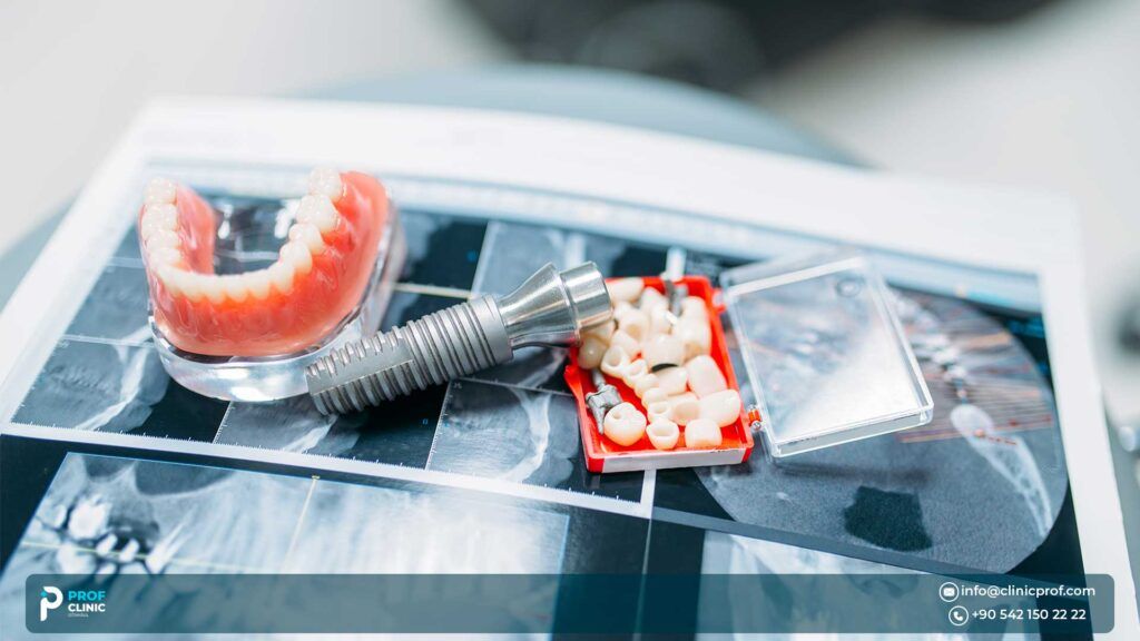Mini dental implants cost