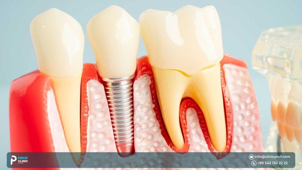 Other Procedures You May Have With Implants