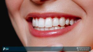 Porcelain Veneers: The Ultimate Guide to a Perfect Smile