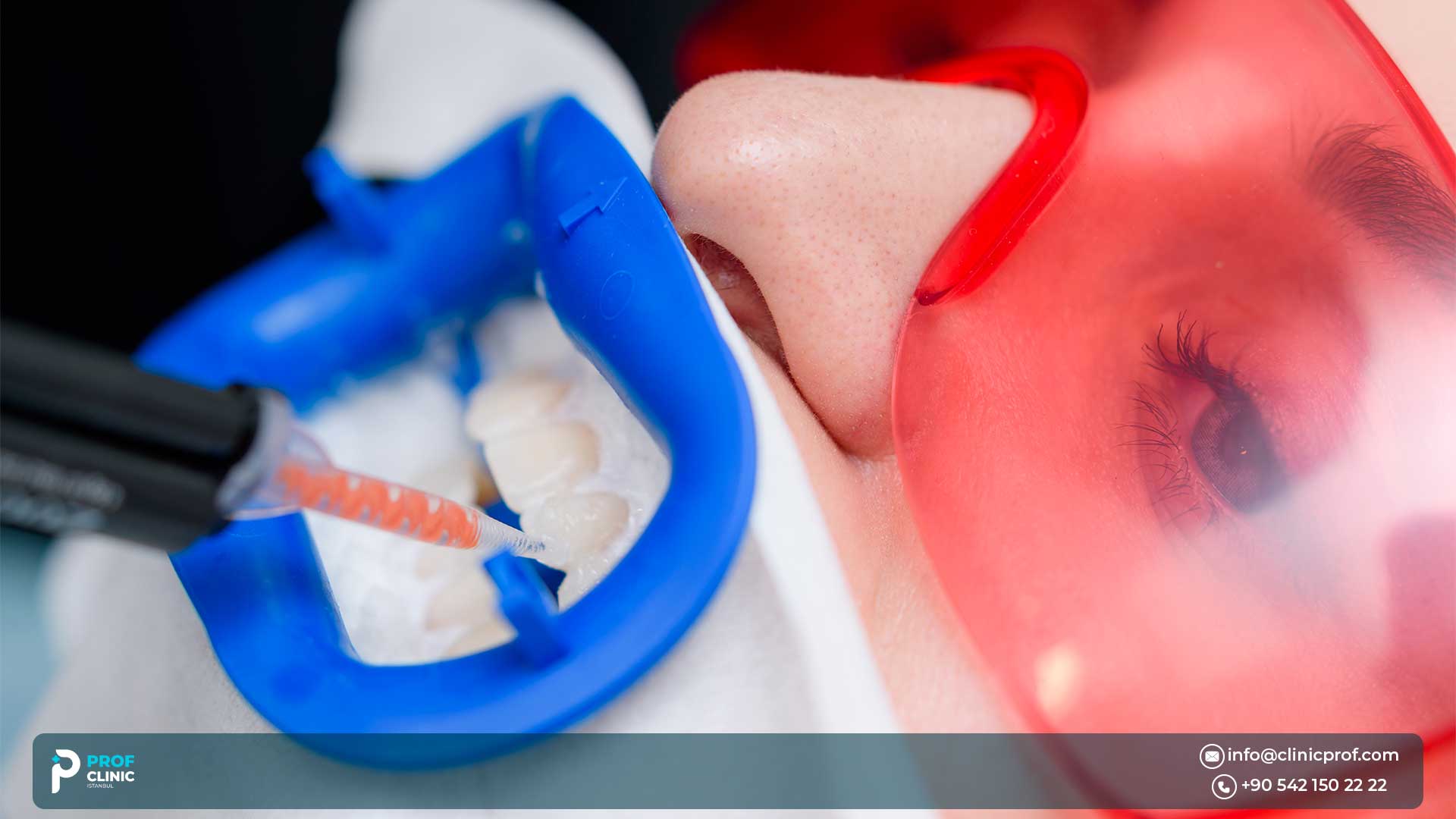 Porcelain vs. Composite Veneers
