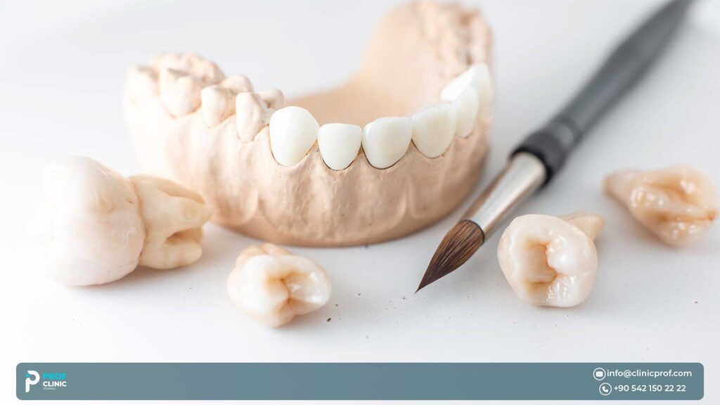 Prof Clinic is the Best Clinic for Emax Crowns in Turkey
