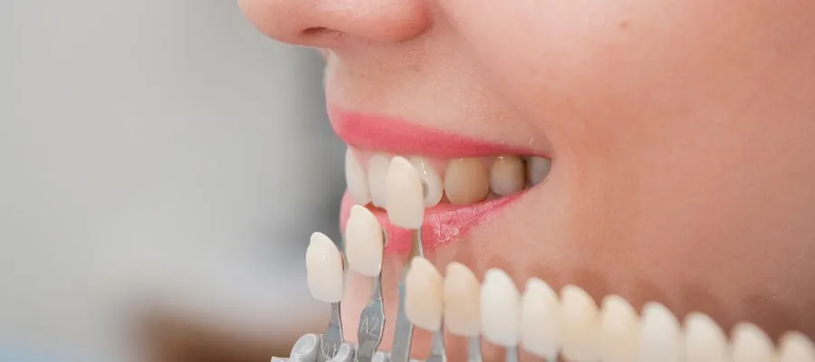 Pros and Cons of Emax Veneers2