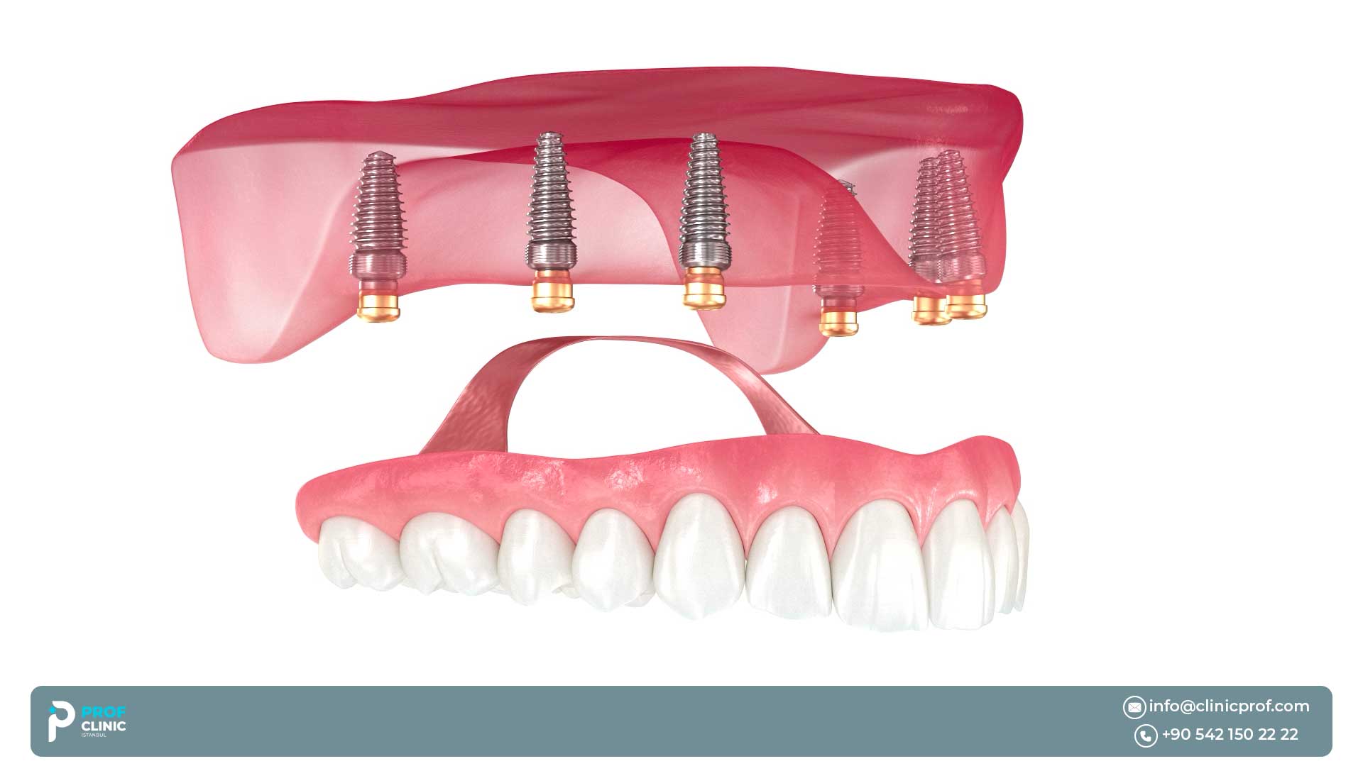 Pros & cons of All on Six Dental Implants