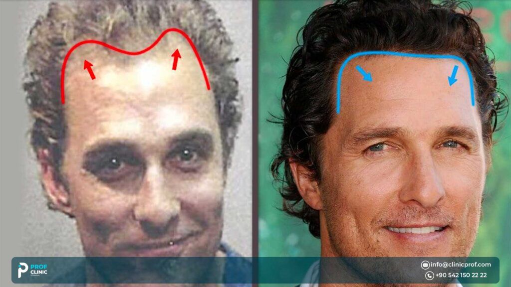 Hair Transplant